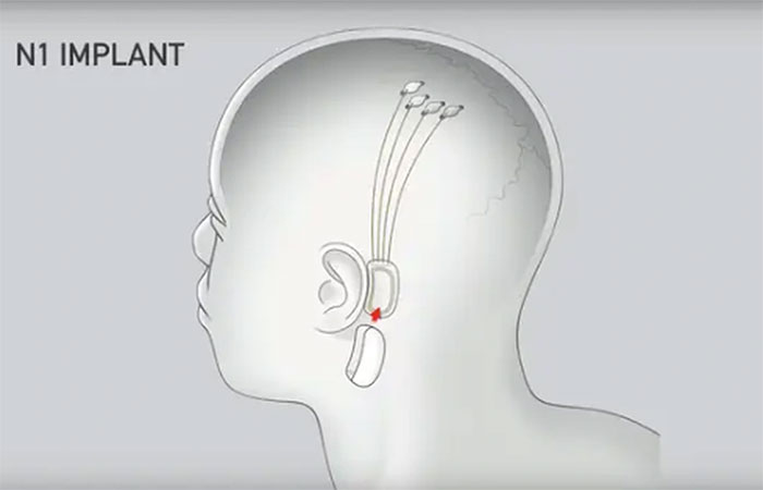 Con chip sẽ nằm phía sau tai và có các dây dẫn nối với các điện cực tiếp xúc với não.