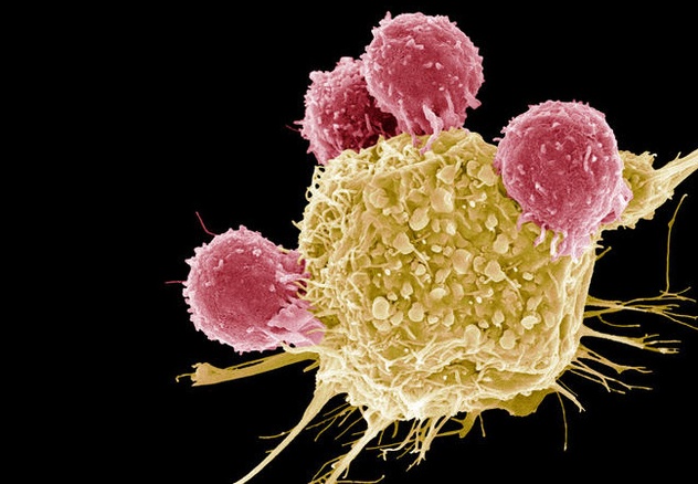 Ảnh chụp qua kính hiển vi mầu cho thấy các tế bào T (màu hồng) đang tấn công tế bào ung thư (màu vàng).